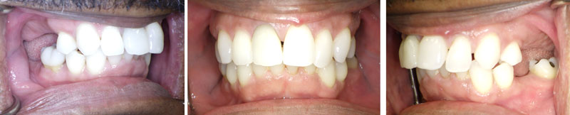 Overbite correction Houston adult patient