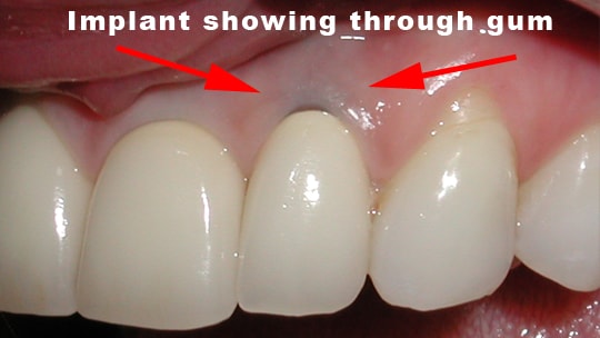 Implant problems