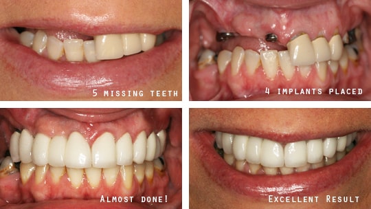 Dental Implant case before and after