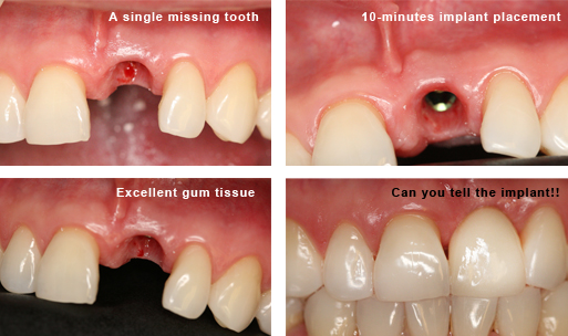 Dental Implant before and after