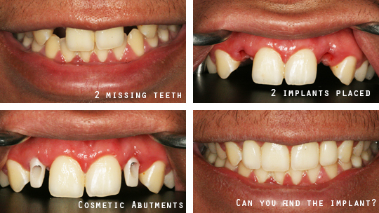 Dental Implants before and after