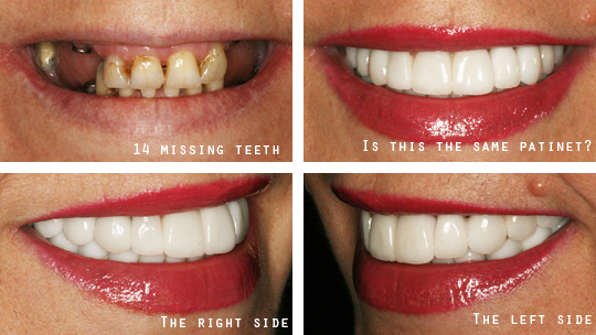 Dental Implant before and after