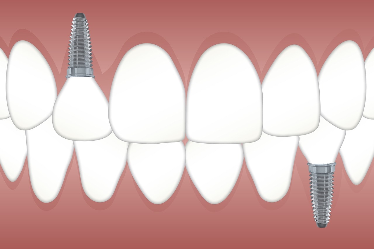 Affordable Dental Implants Sugar Land