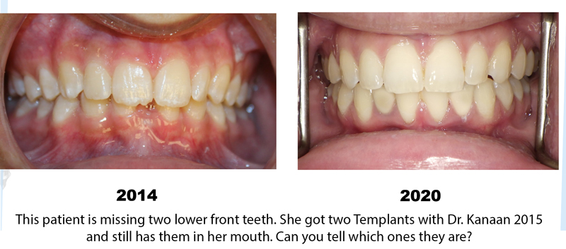 dental implant for children Sugar land texas Houston