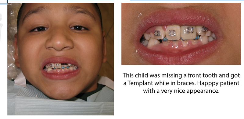 a child with missing a front tooth temporay dental implant Houston texas 77478