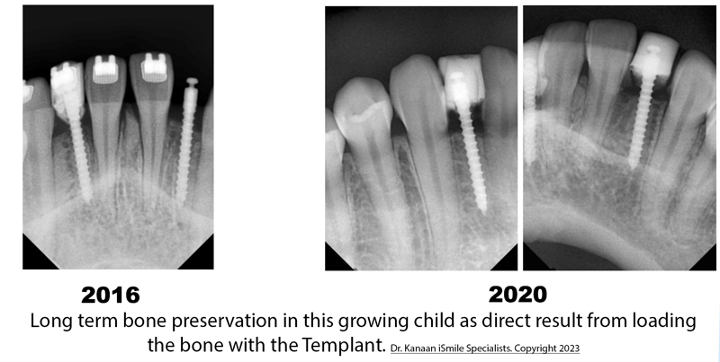 Long term success of temporary dental implant for children