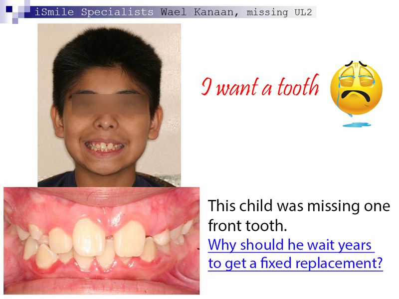 a child with missing a front tooth