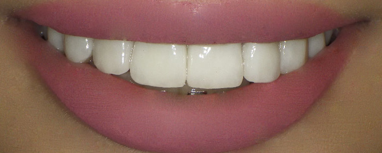 Dental Veeners
