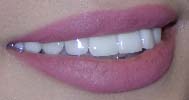 Veneers Houston