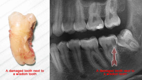 wisdom teeth damage