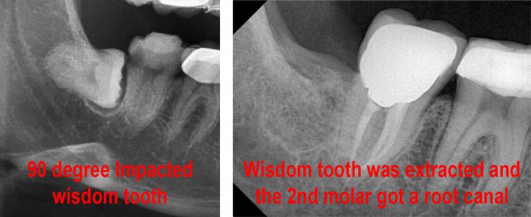 cheap wisdom teeth extraction Houston