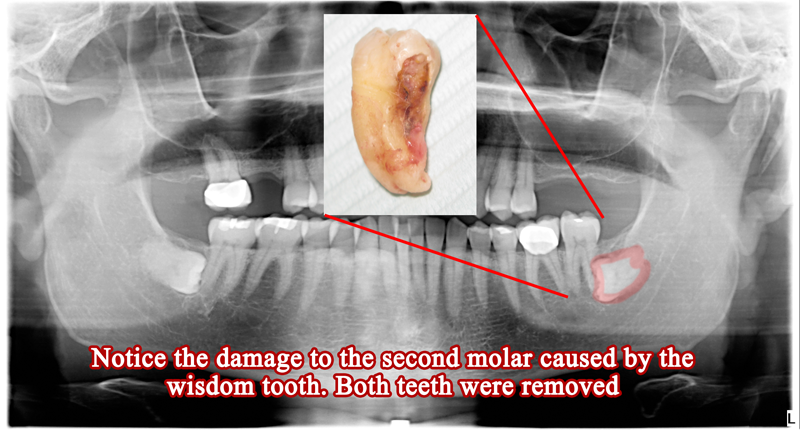 wisdom teeth damaging adjacent teeth