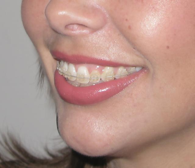 Clear Braces in Houston