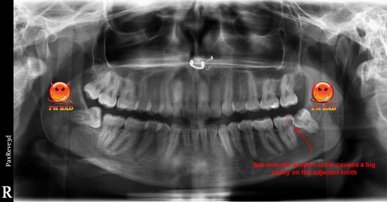 Damage from wisdom teeth