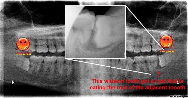 Wisdom teeth damage with cyst formation
