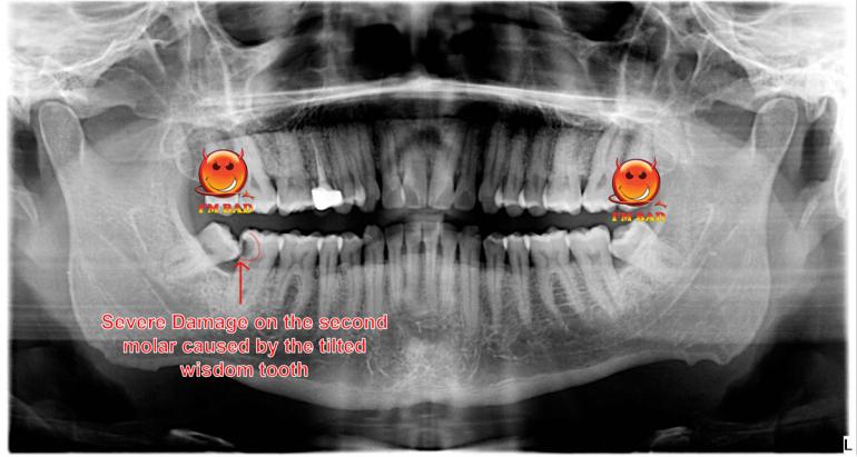 Damage to the second molar from the right wisdom tooth