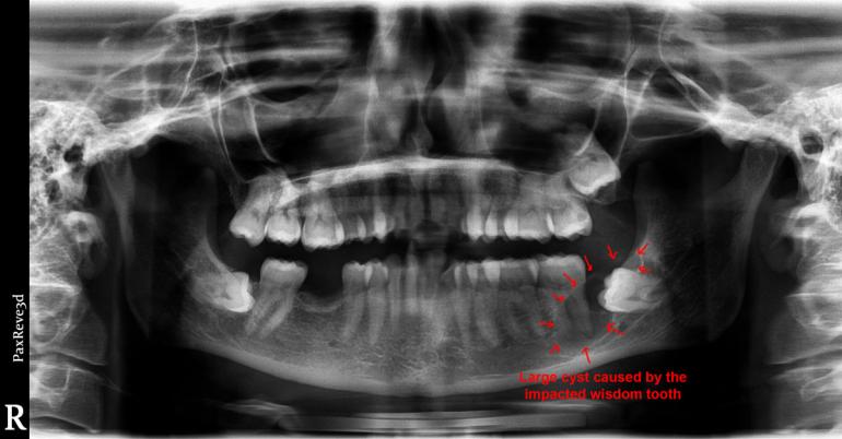 wisdom tooth with a large cyst