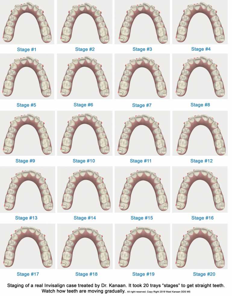 How invisalign works to move your teeth
