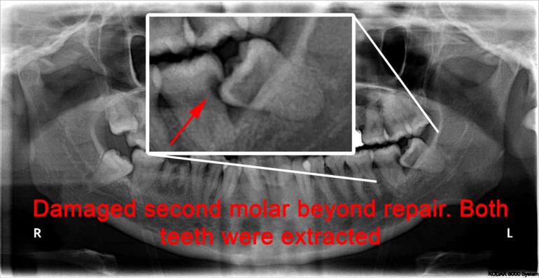 Wisdom tooth damages to adjacent teeth