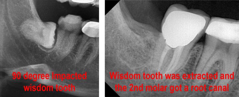 wisdom teeth damage 6