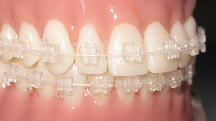 Phantom clear braces with clear wires in Houston and Sugar Land Phantom clear braces with clear wires in Houston and Sugar Land