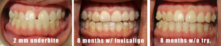 Invisalign underbite correction without surgery sugar Land Houston