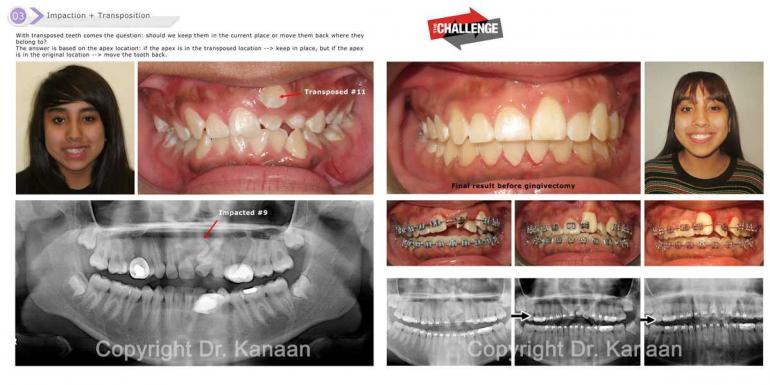 Impacted central Incisor tooth surgery Houston Sugar Land Impacted central Incisor tooth surgery Houston Sugar Land