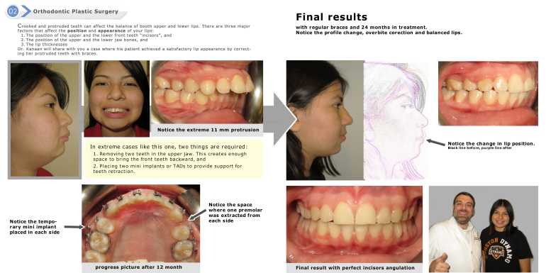 overbite correction with TADs Houston orthodontist
