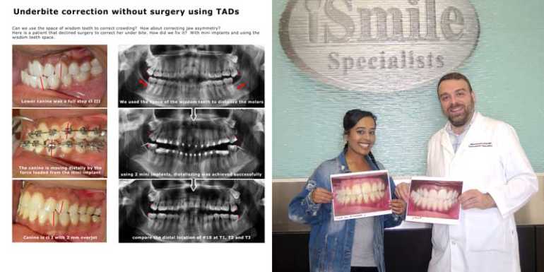 Underbite correction with TADs Houston orthodontist