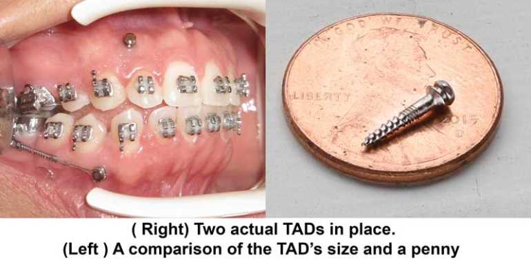 TADs in Houston Orthodontist mini implants