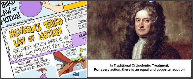 TADs and the third law of Newton's Isaac Newton TAD houston orthodontist