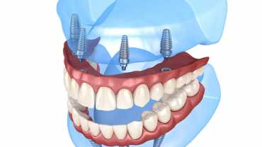 All-on-4 dental implants