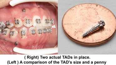 TADs in Houston Orthodontist mini implants