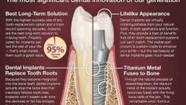Dental Implants Infographic