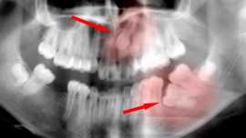 Impacted Canine Molar