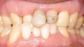 Complex Orthodontic Cases