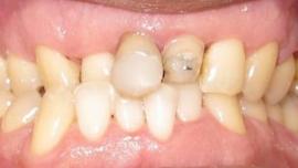 Complex Orthodontic Cases