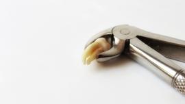 wisdom-tooth-houston