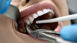 Teeth Extraction 