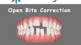 Anterior open bite correction with Invisalign in Houston 