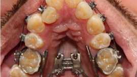 Miniscrew-Assisted Rapid Palatal Expansion technique MARPE
