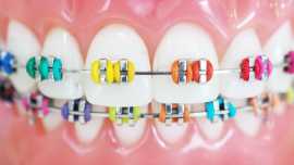 Braces Color Combination