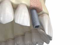 Dental Bone Graph