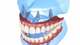 All-on-4 dental implants