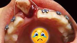 Trauma to a front tooth