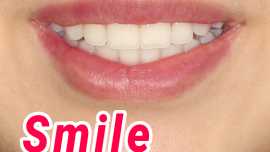 Smile better with braces