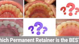 Permanent Retainer in Houston