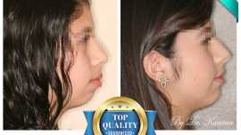 protruding teeth correction Houston