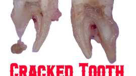 Cracket tooth treatment in houston