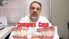 Adult overbite correction
